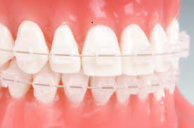 Брекеты керамические Dream clear 0.22 (20шт)